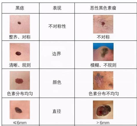 黑痣癌变早期|黑色素痣癌变的过程，早期症状